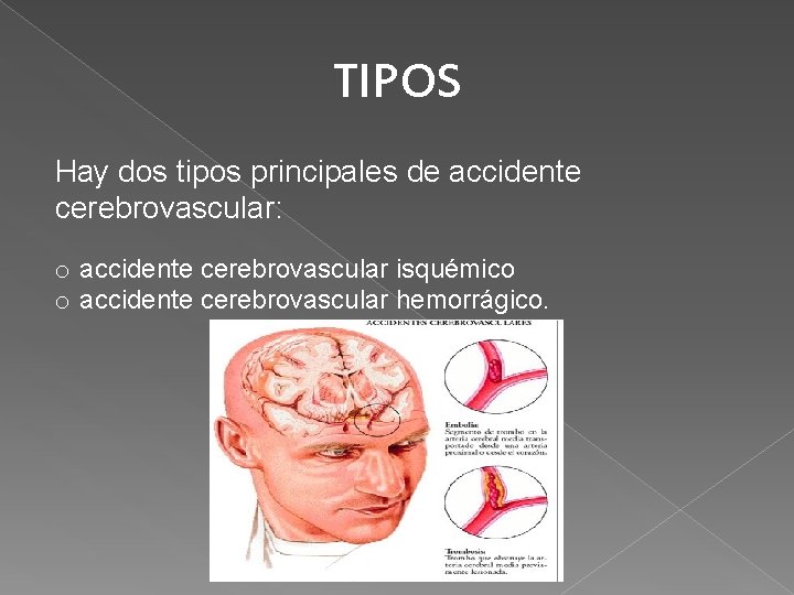 TIPOS Hay dos tipos principales de accidente cerebrovascular: o accidente cerebrovascular isquémico o accidente