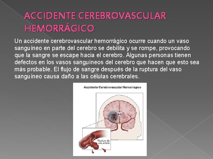 ACCIDENTE CEREBROVASCULAR HEMORRÁGICO Un accidente cerebrovascular hemorrágico ocurre cuando un vaso sanguíneo en parte