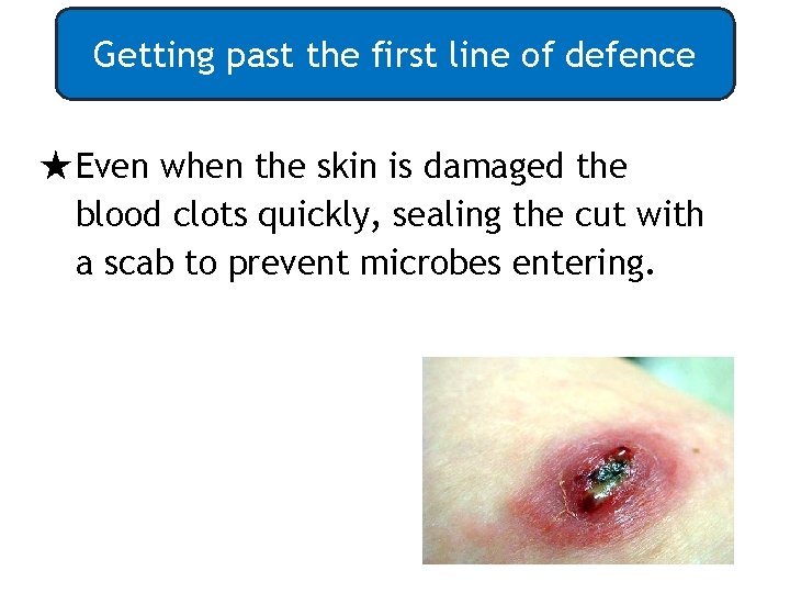 Getting past the first line of defence ★Even when the skin is damaged the