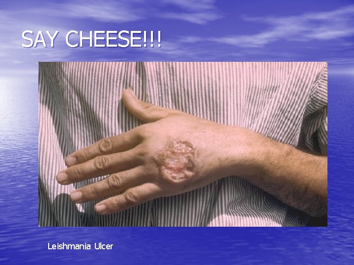 SAY CHEESE!!! Leishmania Ulcer 