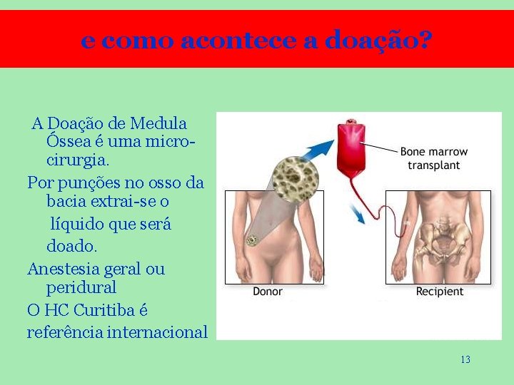 e como acontece a doação? A Doação de Medula Óssea é uma microcirurgia. Por