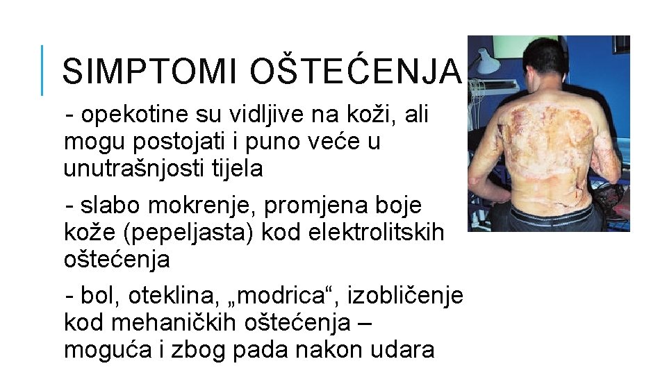 SIMPTOMI OŠTEĆENJA - opekotine su vidljive na koži, ali mogu postojati i puno veće