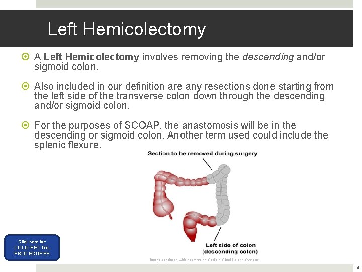 Left Hemicolectomy A Left Hemicolectomy involves removing the descending and/or sigmoid colon. Also included Left Hemicolectomy A Left Hemicolectomy involves removing the descending and/or sigmoid colon. Also included