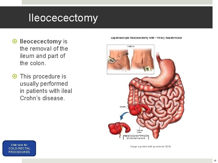 Ileocecectomy is the removal of the ileum and part of the colon. This procedure