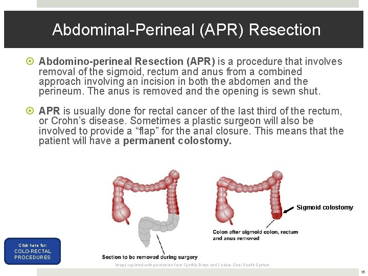 Abdominal-Perineal (APR) Resection Abdomino-perineal Resection (APR) is a procedure that involves removal of the