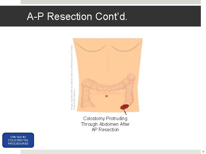 Image reprinted with permission from Cynthia Broze and Cedars. Sinai Health System. A-P Resection Image reprinted with permission from Cynthia Broze and Cedars. Sinai Health System. A-P Resection