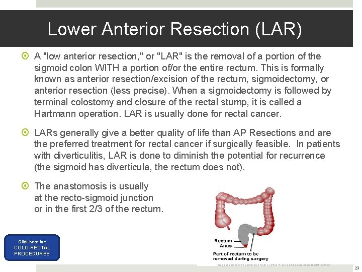 Lower Anterior Resection (LAR) A "low anterior resection, " or "LAR" is the removal