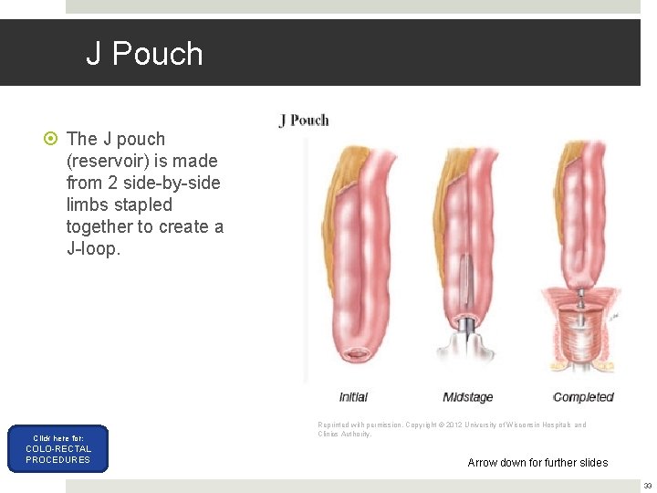 J Pouch The J pouch (reservoir) is made from 2 side-by-side limbs stapled together J Pouch The J pouch (reservoir) is made from 2 side-by-side limbs stapled together