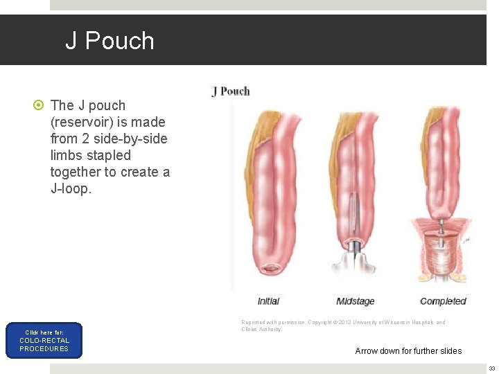 J Pouch The J pouch (reservoir) is made from 2 side-by-side limbs stapled together