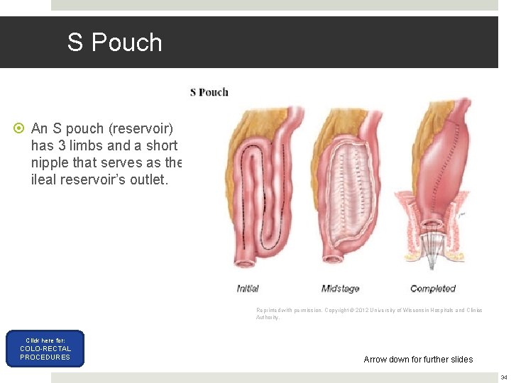 S Pouch An S pouch (reservoir) has 3 limbs and a short nipple that