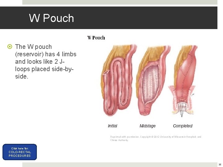 W Pouch The W pouch (reservoir) has 4 limbs and looks like 2 Jloops