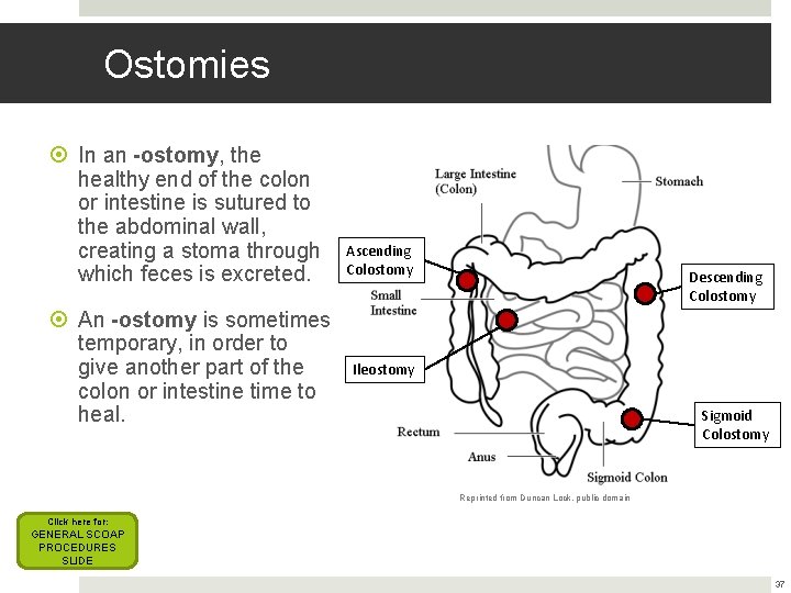 Ostomies In an -ostomy, the healthy end of the colon or intestine is sutured