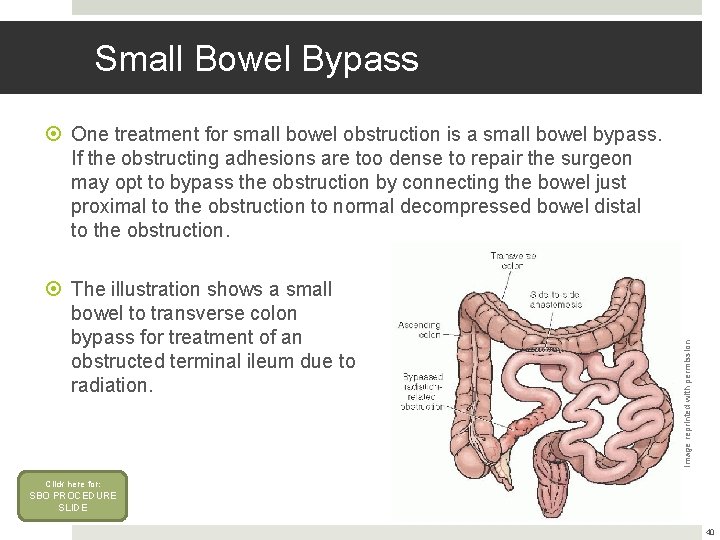 Small Bowel Bypass The illustration shows a small bowel to transverse colon bypass for