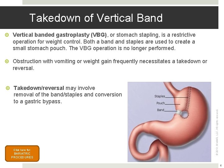 Takedown of Vertical Band Vertical banded gastroplasty (VBG), or stomach stapling, is a restrictive