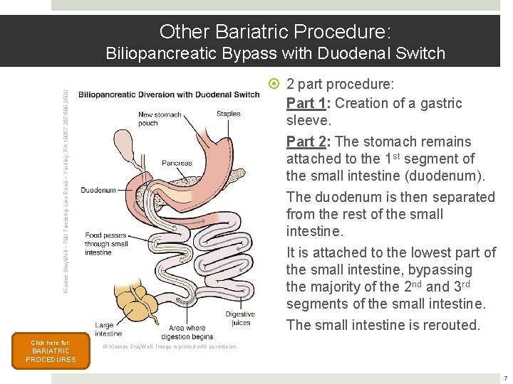 Other Bariatric Procedure: Biliopancreatic Bypass with Duodenal Switch Krames Stay. Well ~ 780 Township