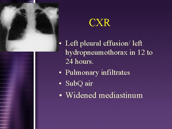 CXR • Left pleural effusion/ left hydropneumothorax in 12 to 24 hours. • Pulmonary