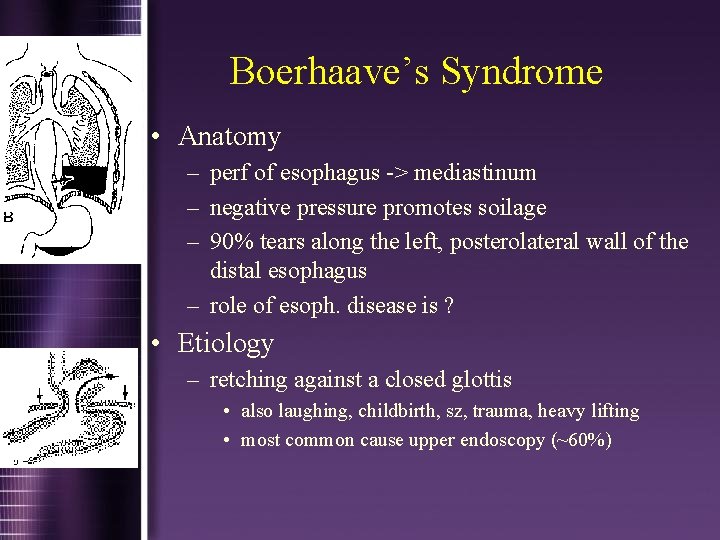 Boerhaave’s Syndrome • Anatomy – perf of esophagus -> mediastinum – negative pressure promotes