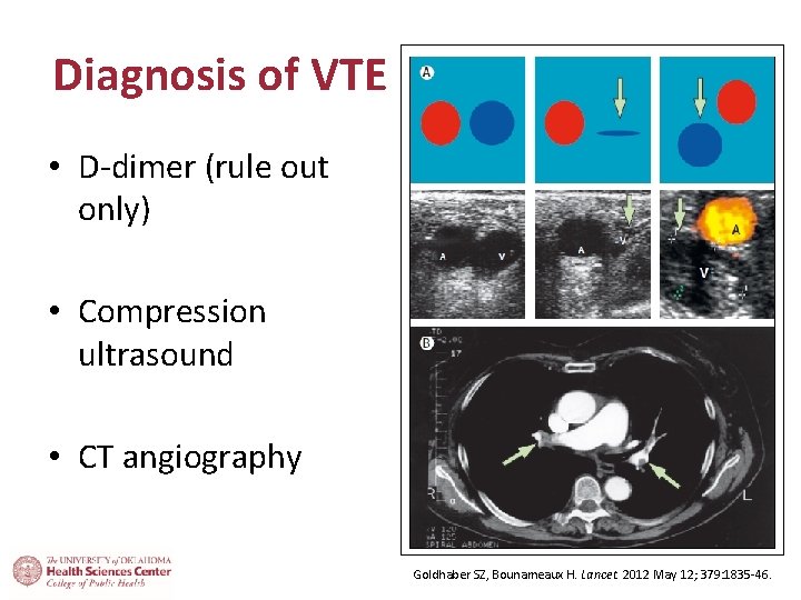 Diagnosis of VTE • D-dimer (rule out only) • Compression ultrasound • CT angiography