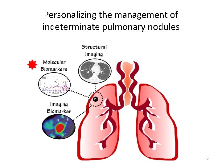 Personalizing the management of indeterminate pulmonary nodules 45 