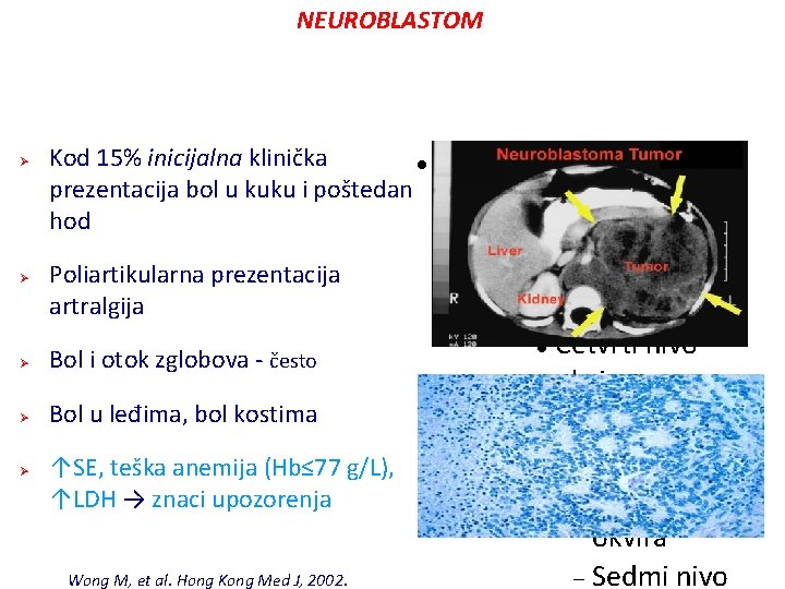 NEUROBLASTOM Ø Ø Kod 15% inicijalna klinička Kliknite da uredite oblik prezentacija bol u