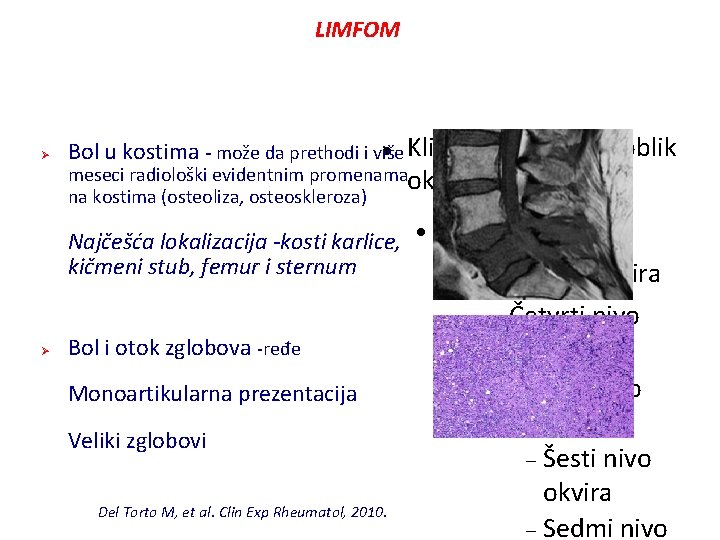 LIMFOM Ø Kliknite da uredite oblik Bol u kostima - može da prethodi i