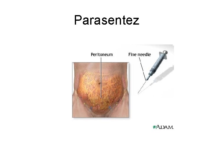 Parasentez 