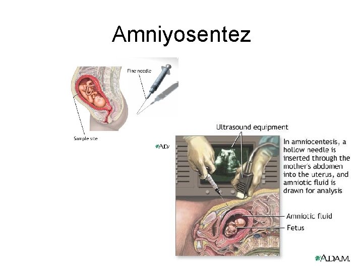 Amniyosentez 