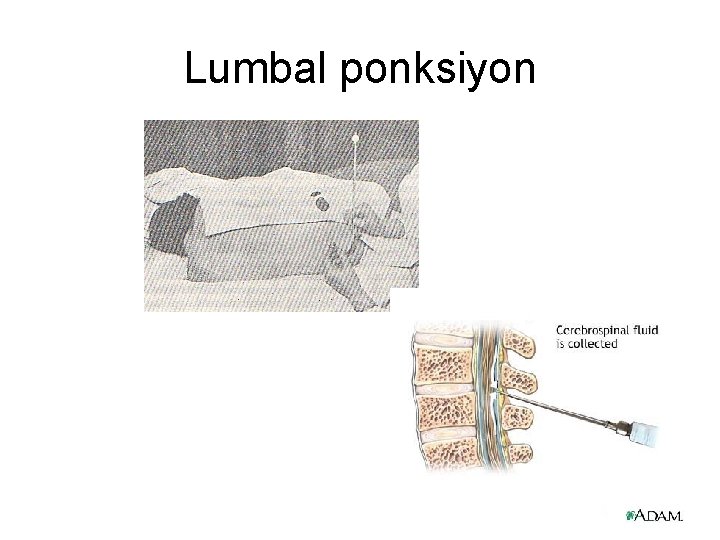 Lumbal ponksiyon 