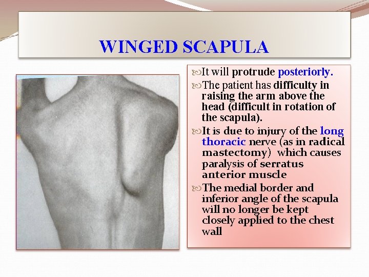 WINGED SCAPULA It will protrude posteriorly. The patient has difficulty in raising the arm