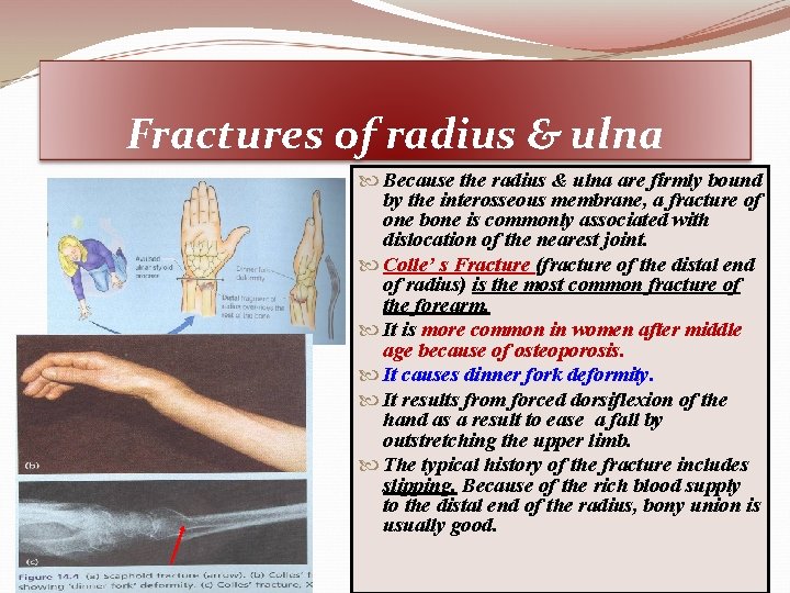 Fractures of radius & ulna Because the radius & ulna are firmly bound by