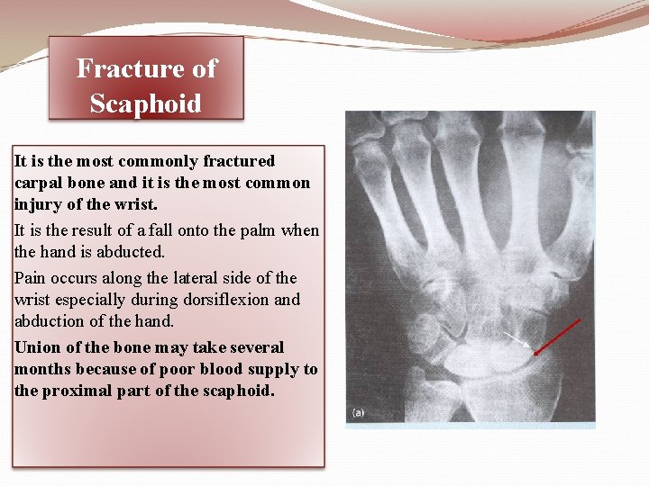 Fracture of Scaphoid It is the most commonly fractured carpal bone and it is