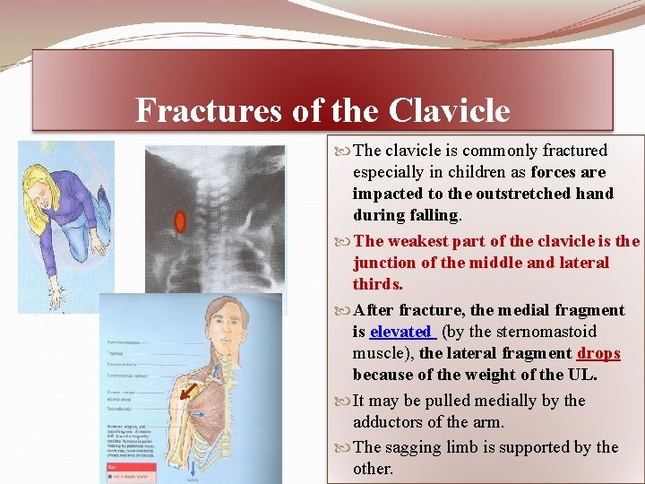 Fractures of the Clavicle The clavicle is commonly fractured especially in children as forces