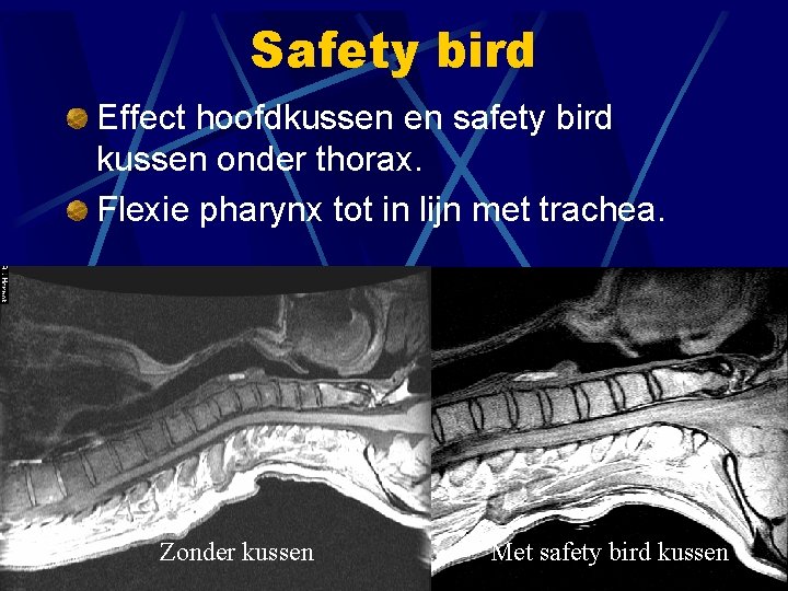 Safety bird Effect hoofdkussen en safety bird kussen onder thorax. Flexie pharynx tot in