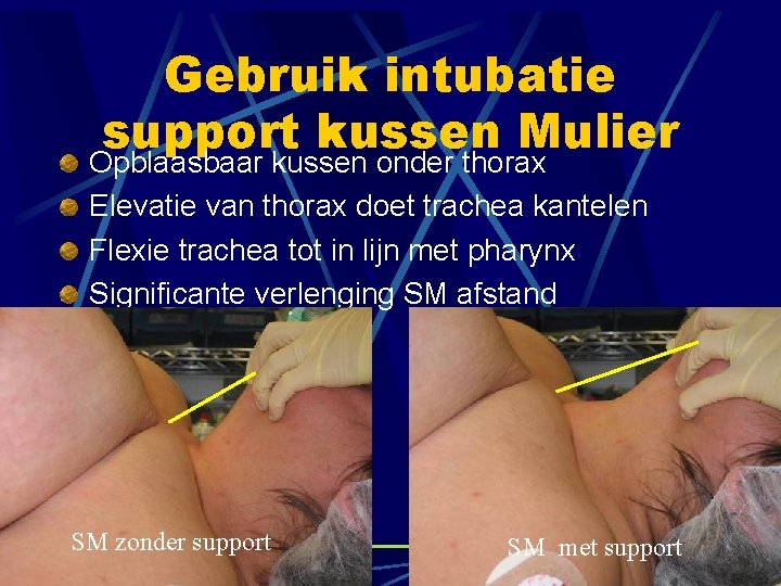 Gebruik intubatie support kussen Mulier Opblaasbaar kussen onder thorax Elevatie van thorax doet trachea Gebruik intubatie support kussen Mulier Opblaasbaar kussen onder thorax Elevatie van thorax doet trachea