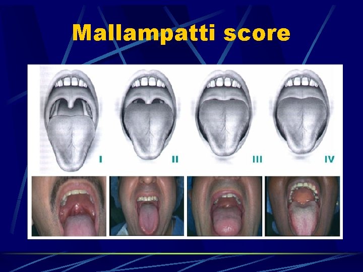Mallampatti score 