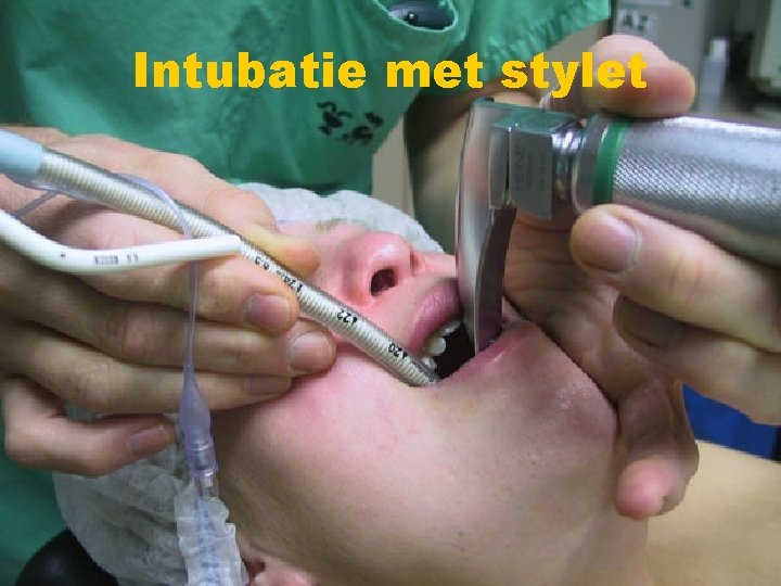 Intubatie met stylet Intubatie met stylet