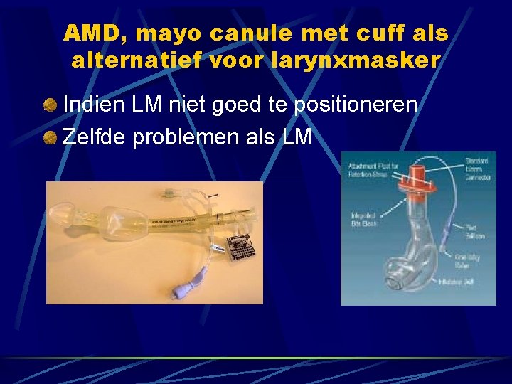 AMD, mayo canule met cuff als alternatief voor larynxmasker Indien LM niet goed te