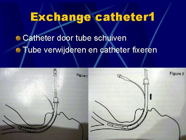 Exchange catheter 1 Catheter door tube schuiven Tube verwijderen en catheter fixeren 
