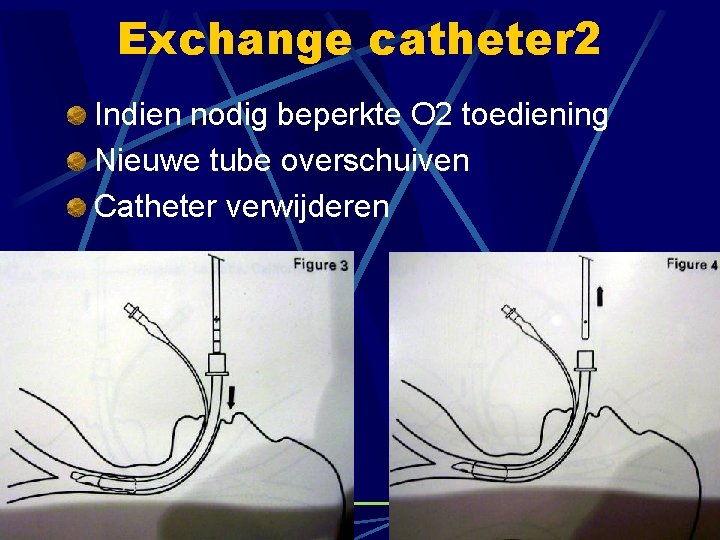 Exchange catheter 2 Indien nodig beperkte O 2 toediening Nieuwe tube overschuiven Catheter verwijderen