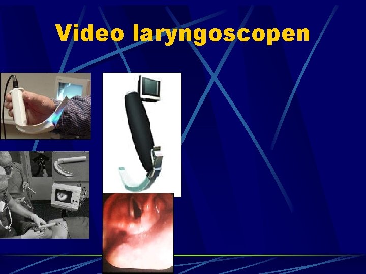 Video laryngoscopen 