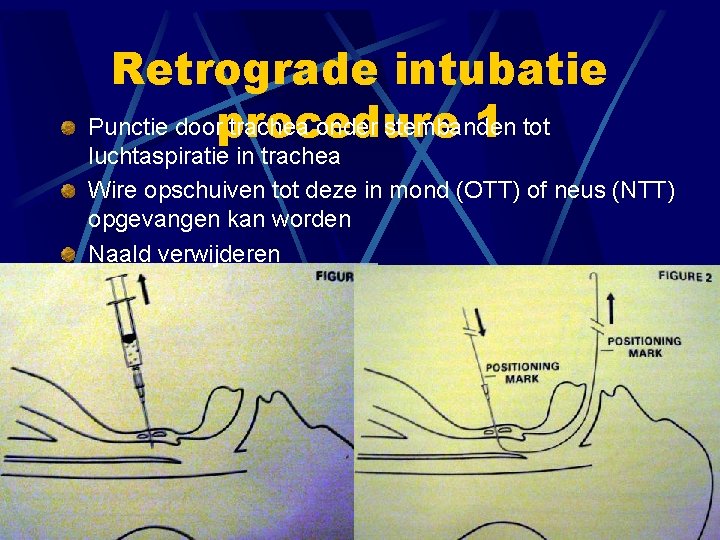 Retrograde intubatie Punctie doorprocedure trachea onder stembanden 1 tot luchtaspiratie in trachea Wire opschuiven