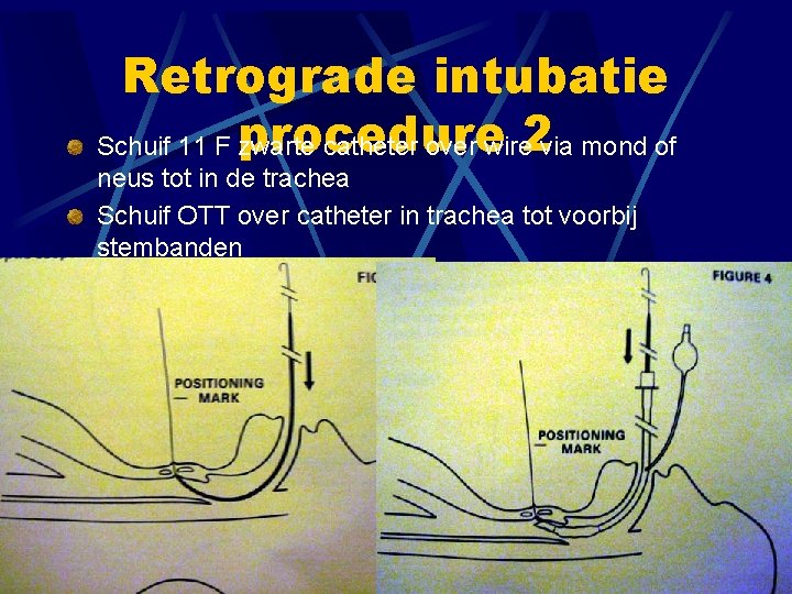Retrograde intubatie Schuif 11 F procedure zwarte catheter over wire 2 via mond of