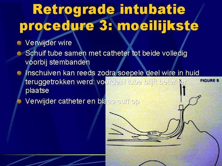 Retrograde intubatie procedure 3: moeilijkste Verwijder wire Schuif tube samen met catheter tot beide