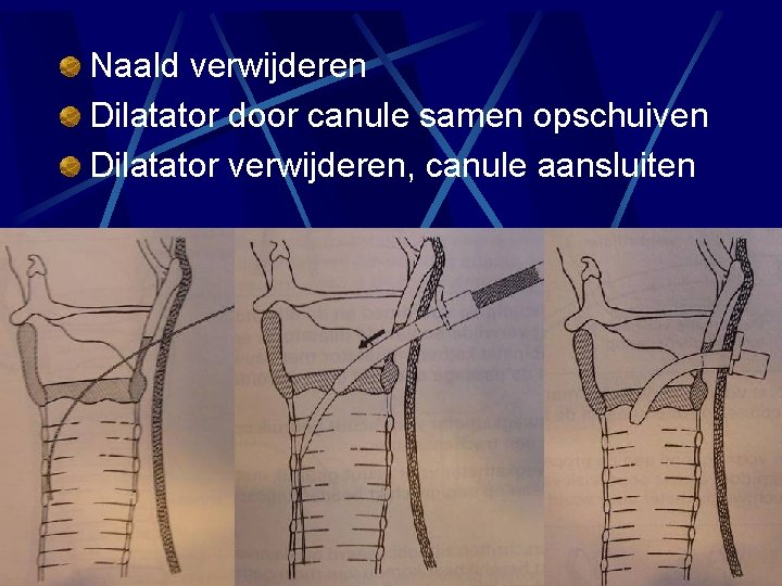 Naald verwijderen Dilatator door canule samen opschuiven Dilatator verwijderen, canule aansluiten Naald verwijderen Dilatator door canule samen opschuiven Dilatator verwijderen, canule aansluiten
