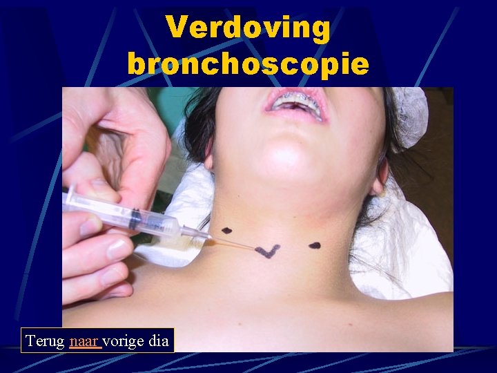 Verdoving bronchoscopie Terug naar vorige dia Verdoving bronchoscopie Terug naar vorige dia