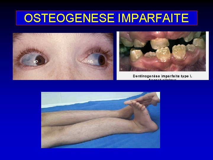 OSTEOGENESE IMPARFAITE 