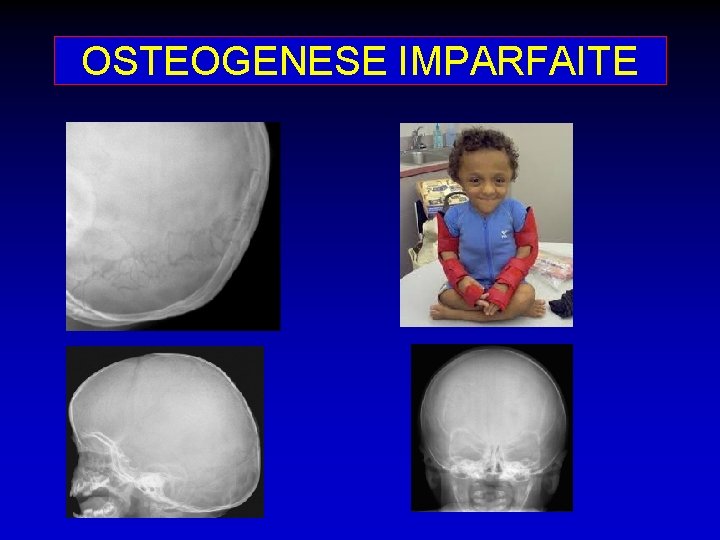 OSTEOGENESE IMPARFAITE 