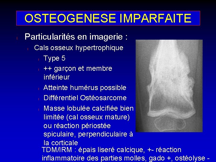 OSTEOGENESE IMPARFAITE l Particularités en imagerie : l Cals osseux hypertrophique l Type 5