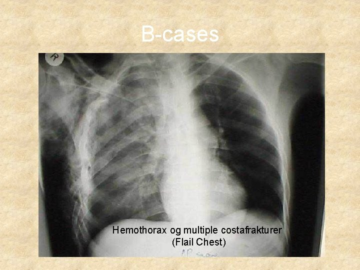 B-cases Hemothorax og multiple costafrakturer (Flail Chest) 