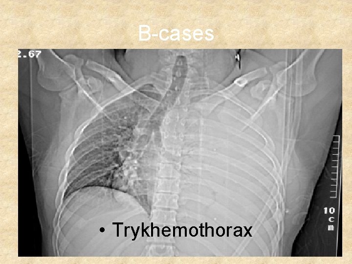 B-cases • Trykhemothorax 